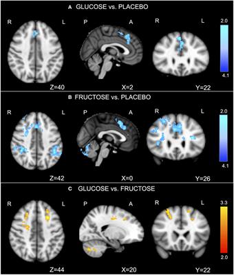 Acute Effects of Glucose and Fructose Administration on the Neural Correlates of Cognitive Functioning in Healthy Subjects: A Pilot Study